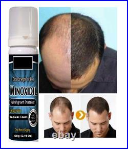 Baldness/Hair Loss/Alopecia/Thinning Hair Extra Strength Treatment Foam