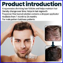 Baldness/Hair Loss/Alopecia/Thinning Hair Extra Strength Treatment Foam