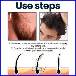 Baldness/Hair Loss/Alopecia/Thinning Hair Extra Strength Treatment Foam