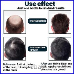 Baldness/Hair Loss/Alopecia/Thinning Hair Extra Strength Treatment Foam