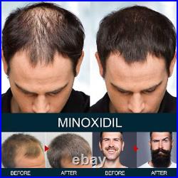 Baldness/Hair Loss/Alopecia/Thinning Hair Extra Strength Treatment Foam