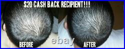 Laser Comb Hair Growth Loss Regrowth Treatment (28x More Power Than Others!)