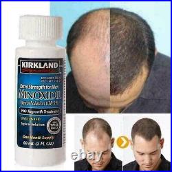 Minoxidil 5% Extra Strength Solution For Hair Loss/Baldness/Alopecia 12 Months
