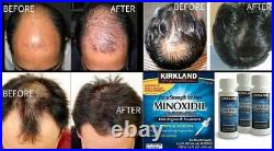 Minoxidil 5% Extra Strength Solution For Hair Loss/Baldness/Alopecia 12 Months